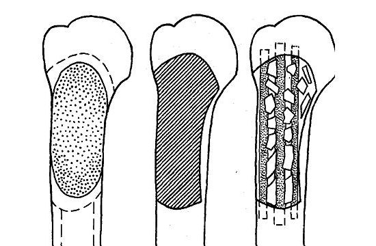 Резекция костной ткани кисты