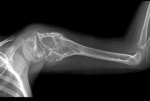 Саркома руки на рентген снимке