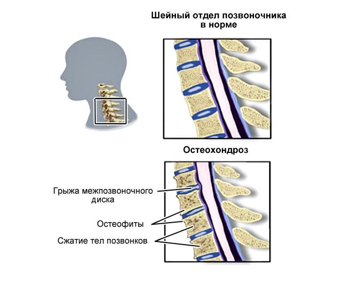 Схема шейного остеохондроза