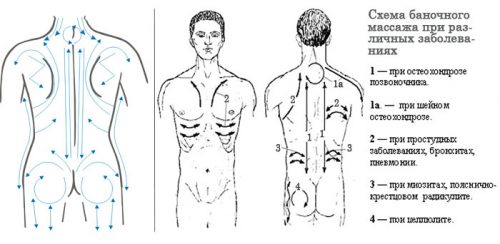 Схема баночного массажа при различных заболеваниях