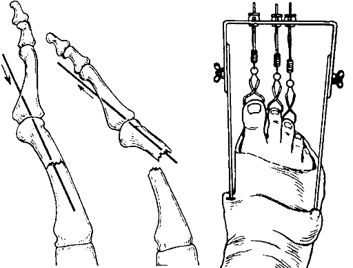 Скелетное вытяжение спицами при переломе стопы