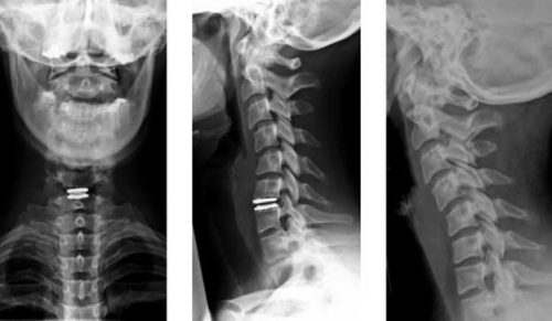 Сколиоз шеи на рентгене
