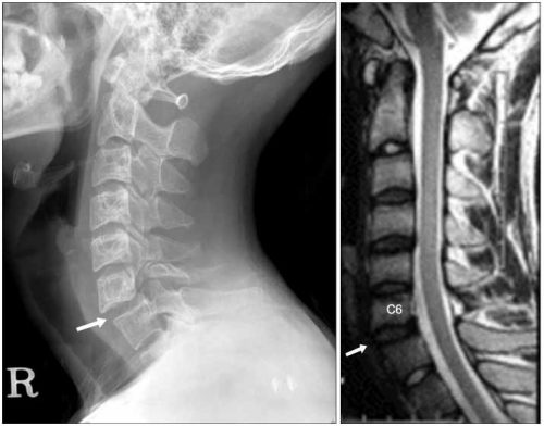 Смещение шейных позвонков на рентгене и МРТ