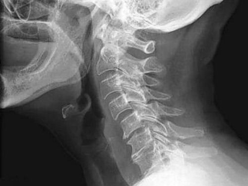 Спондилез шейного отдела на рентген снимке
