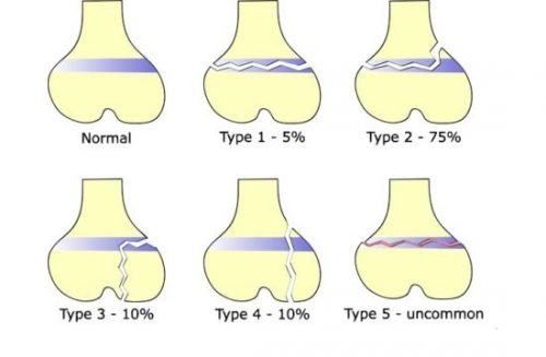 Типы переломов эпифизеолиса колена