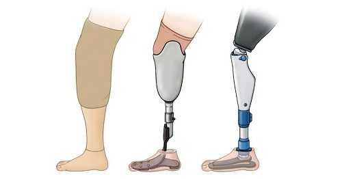 Типы протезов для ног