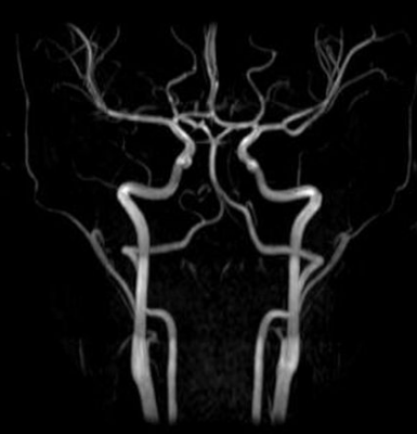 Тромбозы шеи на МР-ангиографии