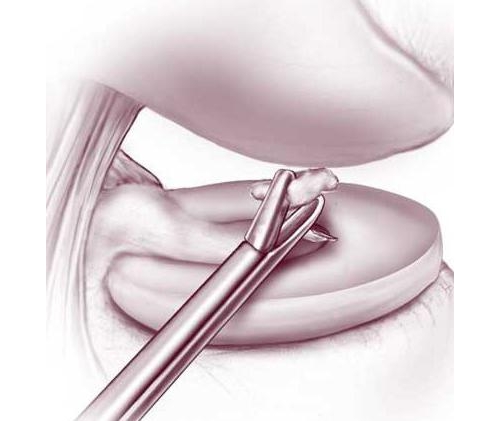Артроскопия суставной мыши коленного сустава