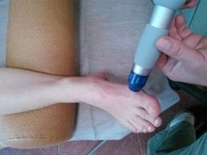 Ударно-волновая терапия от косточки на ноге