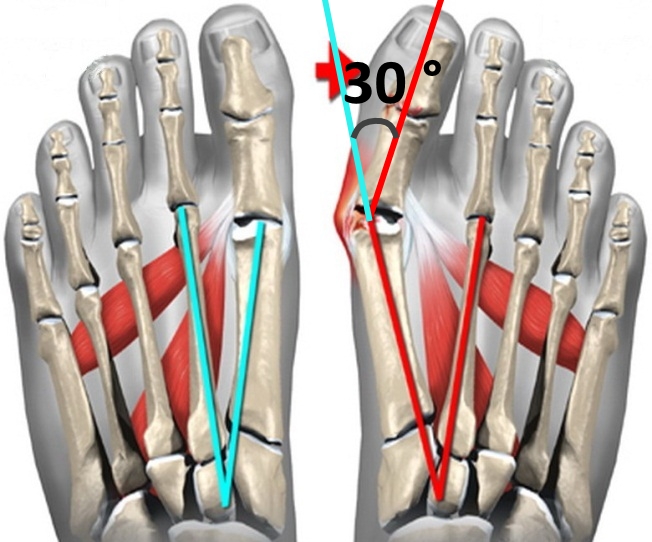 Угол деформации большого пальца стопы