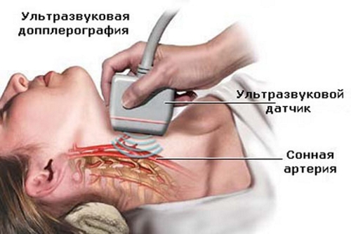 Ультразвуковая допплерография шейного остеохондроза