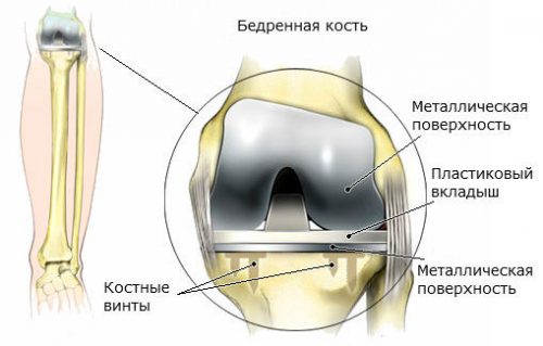 Устройство протеза коленного сустава