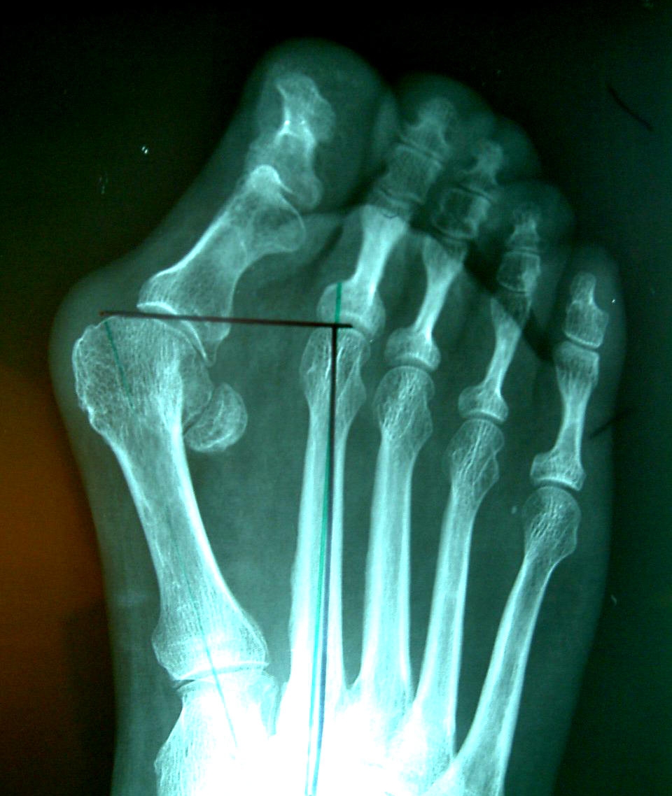 Деформация большого пальца стопы на рентгене