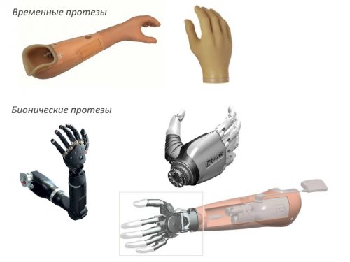 Виды протезов для рук