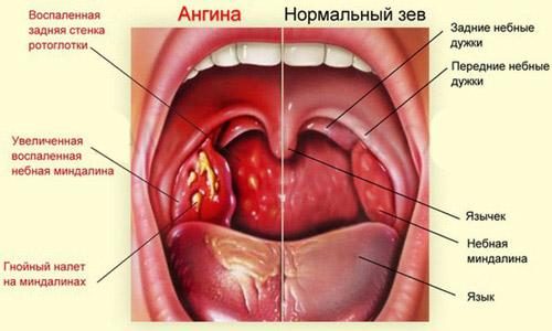 Воспаление горла или ангина