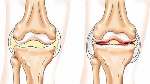 Воспаление менисков колена