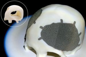Восстановление формы черепа пластинами