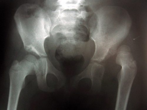 Врожденный вывих бедра на рентген снимке