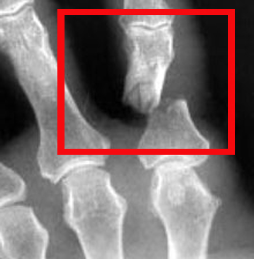 Рентген снимок вывиха пальца на ноге