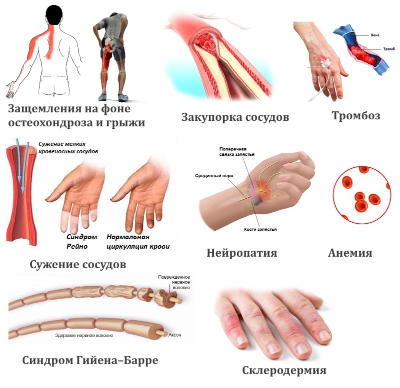 Заболевания — причины онемения пальцев рук