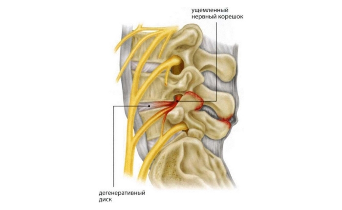 Защемление нервного корешка в спине