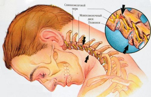 Защемление нервов шеи
