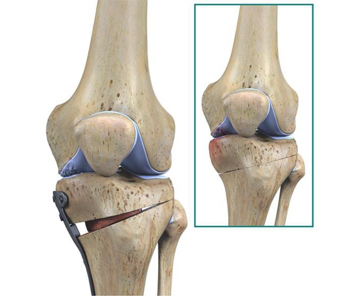 Суставные мыщелки. Высокая корригирующая остеотомия большеберцовой кости. Остеотомия коленного сустава. Корректирующая остеотомия коленного сустава. Операция высокая корригирующая остеотомия большеберцовой кости.